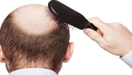 Saç dökülmesi hakkında üç yaygın yanlış inanış