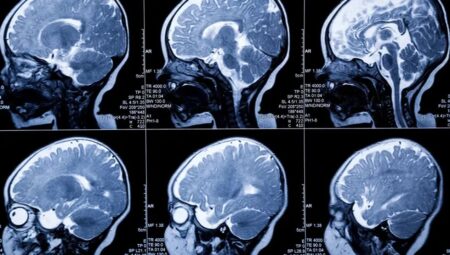 Yenidoğanlardan beyin hasarı erkenden saptanabilir hale geliyor